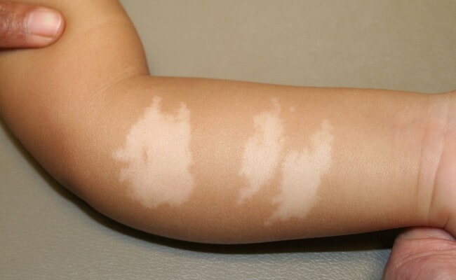 乳児の皮膚の白い斑点